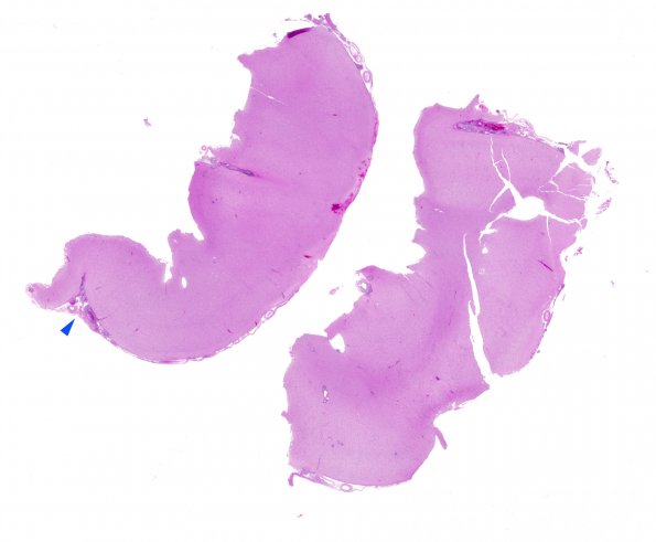 7B1 Vasculitis, granulomatous (Case 7) H&E WM copy