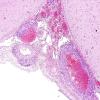 7B2 Vasculitis, granulomatous (Case 7) H&E 6