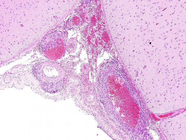 7B2 Vasculitis, granulomatous (Case 7) H&E 6