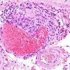 7B3 Vasculitis, granulomatous (Case 7) H&E 7