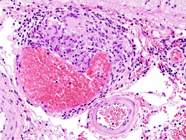 7B3 Vasculitis, granulomatous (Case 7) H&E 7