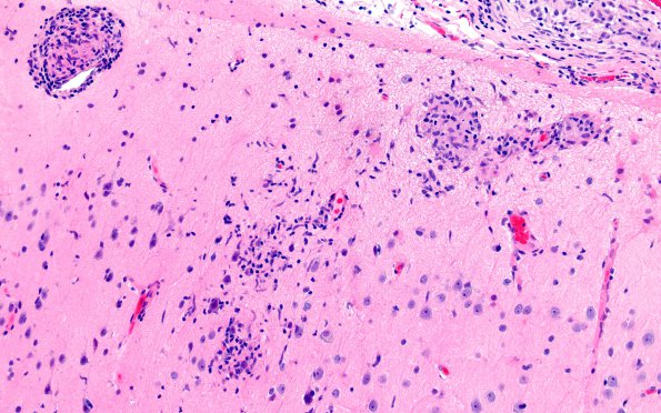 7B5 Granulomatous Angiitis (Case 7) 20X 1