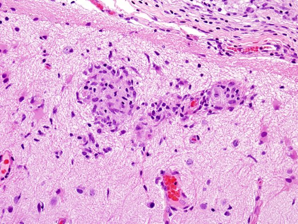 7B6 Vasculitis, granulomatous (Case 7) H&E 8