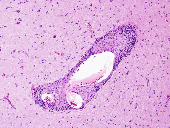 7B7 Vasculitis, granulomatous (Case 7) H&E 4