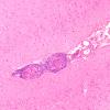 8A1 Granulomatous angiitis (Case 8) H&E 10X A