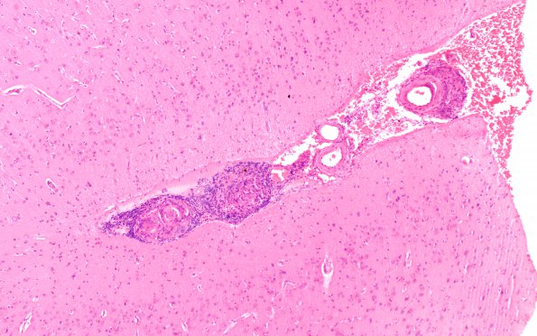 8A1 Granulomatous angiitis (Case 8) H&E 10X A