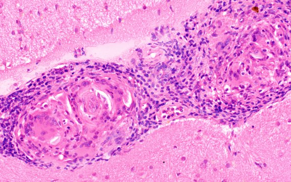 8A2 Granulomatous angiitis (Case 8) H&E 40X A4