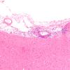 8A3 Granulomatous angiitis (Case 8) H&E 10X 1