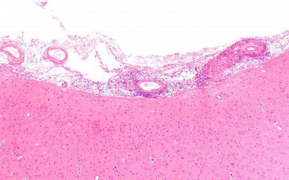 8A3 Granulomatous angiitis (Case 8) H&E 10X 1