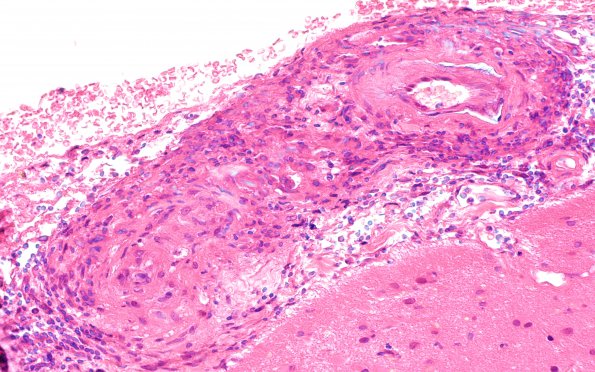 8A4 Granulomatous angiitis (Case 8) H&E 40X 2