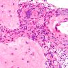 8A5 Granulomatous angiitis (Case 8) H&E 40X A5