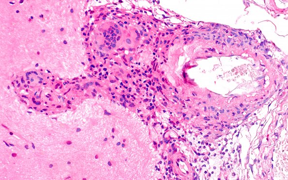 8A5 Granulomatous angiitis (Case 8) H&E 40X A5