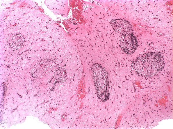 9A1 Vasculitis, Granulomatous Angiitis  (Case 9) 103b