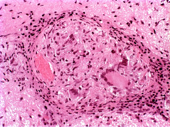 9A3 Vasculitis, Granulomatous Angiitis (Case 9) 103c