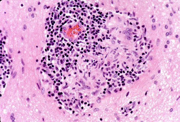 9A3 Vasculitis, Granulomatous Angiitis (Case 9)