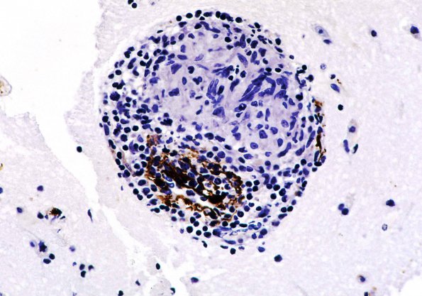 9B Vasculitis, Granulomatous Angiitis SMA (Case 9) A