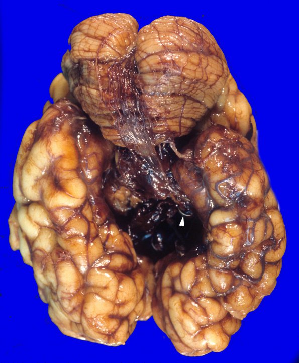 1A1 Vein Galen Aneurysmal Malf (Case 1) 1 copy