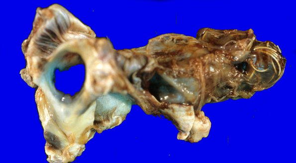 1A2 Vein Galen Aneurysmal Malf (Case 1) 7