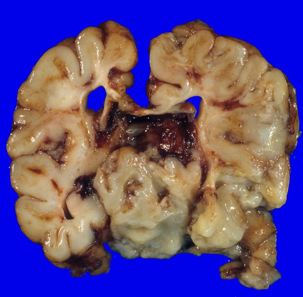 1A3 Vein Galen Aneurysmal Malf (Case 1) 2