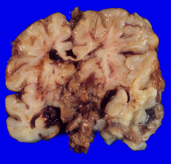 1A4 Vein Galen Aneurysmal Malf (Case 1) 3