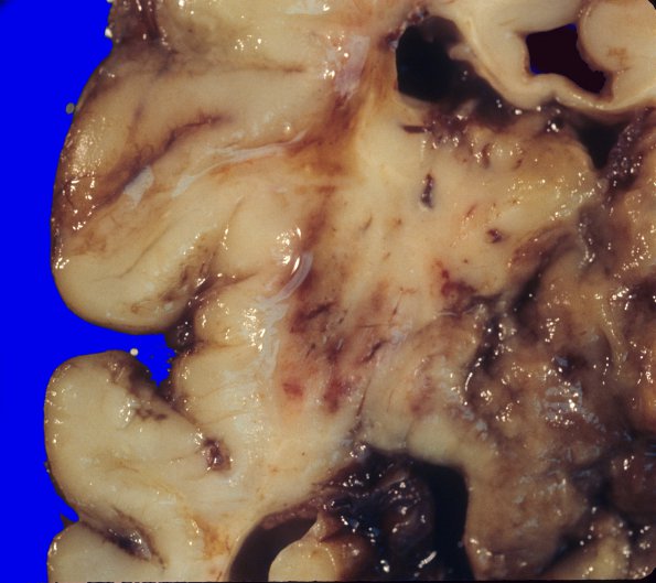 1A5 Vein Galen Aneurysmal Malf (Case 1) 6