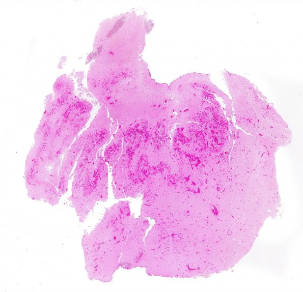 1B8 Vein Galen Aneurysmal Malf (Case 1) N9 WM 3A