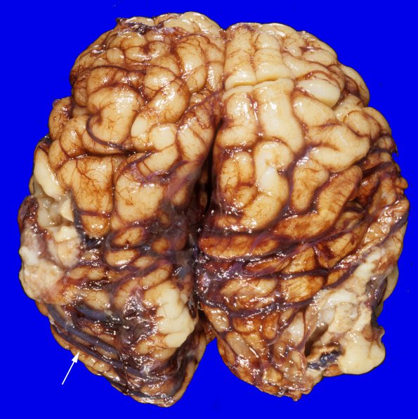 2A1 Vein Galen Aneurysmal Malf (Case 2) A4 copy