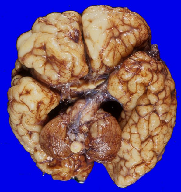 2A3 Vein Galen Aneurysmal Malf (Case 2) A3