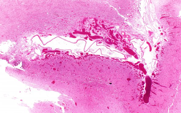 2B2 Vein Galen Aneurysmal Malf (Case 2) H&E N11