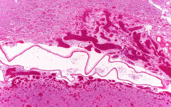 2B3 Vein Galen Aneurysmal Malf (Case 2) N11 B4X