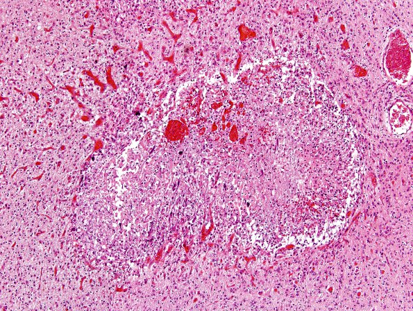 2B5 Vein Galen Aneurysmal Malf (Case 2)