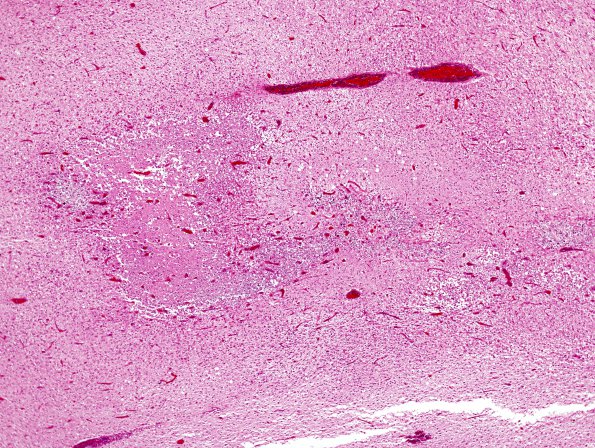 2B6 Vein Galen Aneurysmal Malf (Case 2) 2