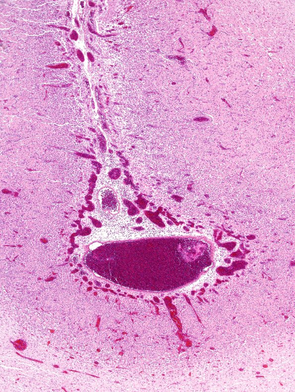 2C2 Vein Galen Aneurysmal Malf (Case 2) A14