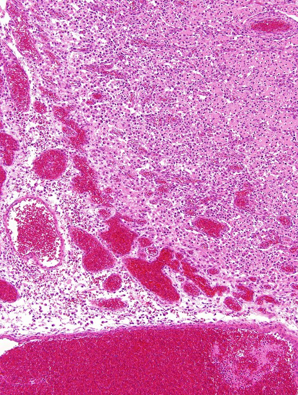 2C3 Vein Galen Aneurysmal Malf (Case 2) A13