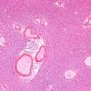 2B4-Venous-angioma-Case-2-N9-H-E-2A.jpg