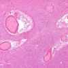 2B5-Venous-angioma-Case-2-N9-H-E-4.jpg