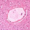 2B7-Venous-angioma-Case-2-N9-H-E-6.jpg